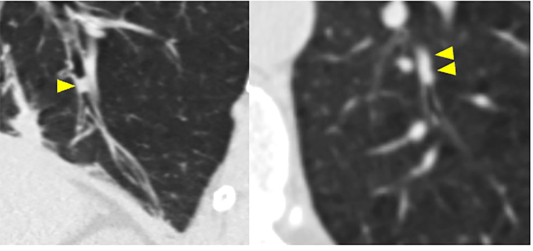 Computer tomography images of mucus plugs (arrowheads) in the lower lobes from a participant in the COPDGene Study. (Picture provided by Alejandro Diaz.)