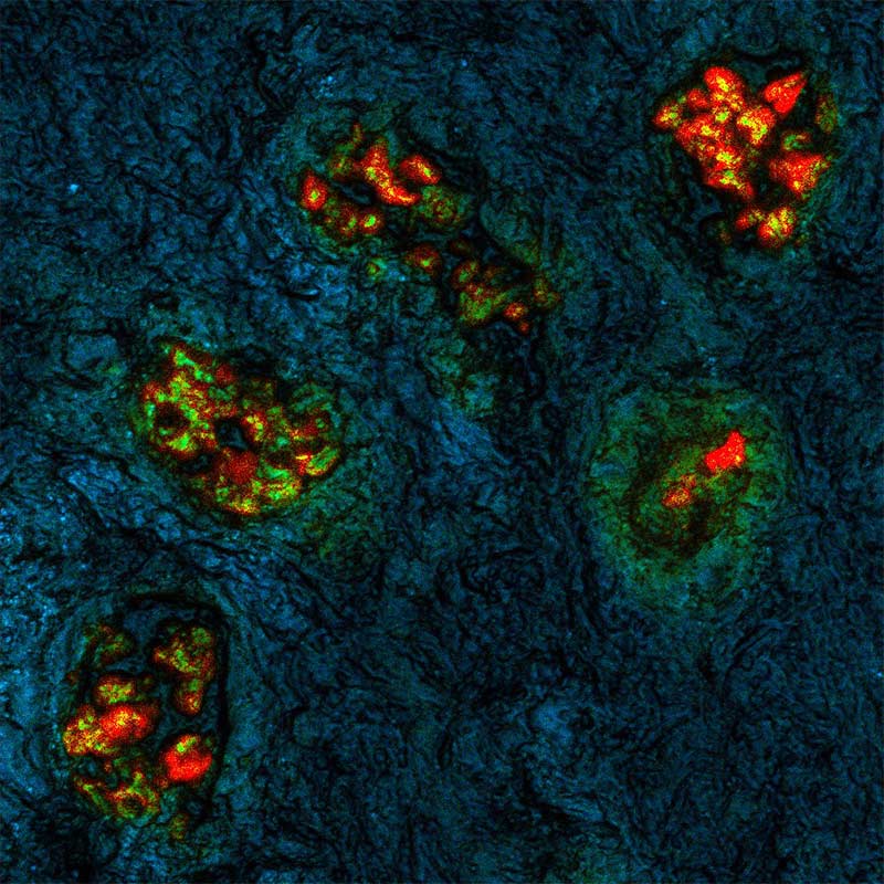  Lymph Metastasis CRC1