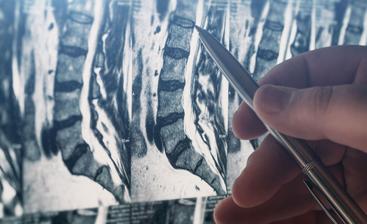 X-ray of Lumbar spine
