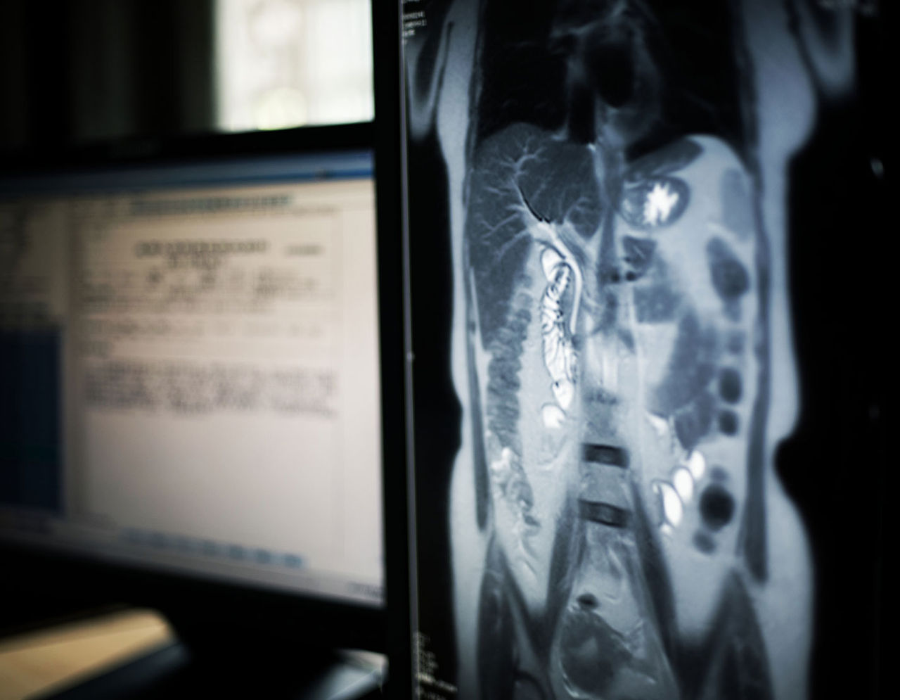 Image scan of abdomen MRI 