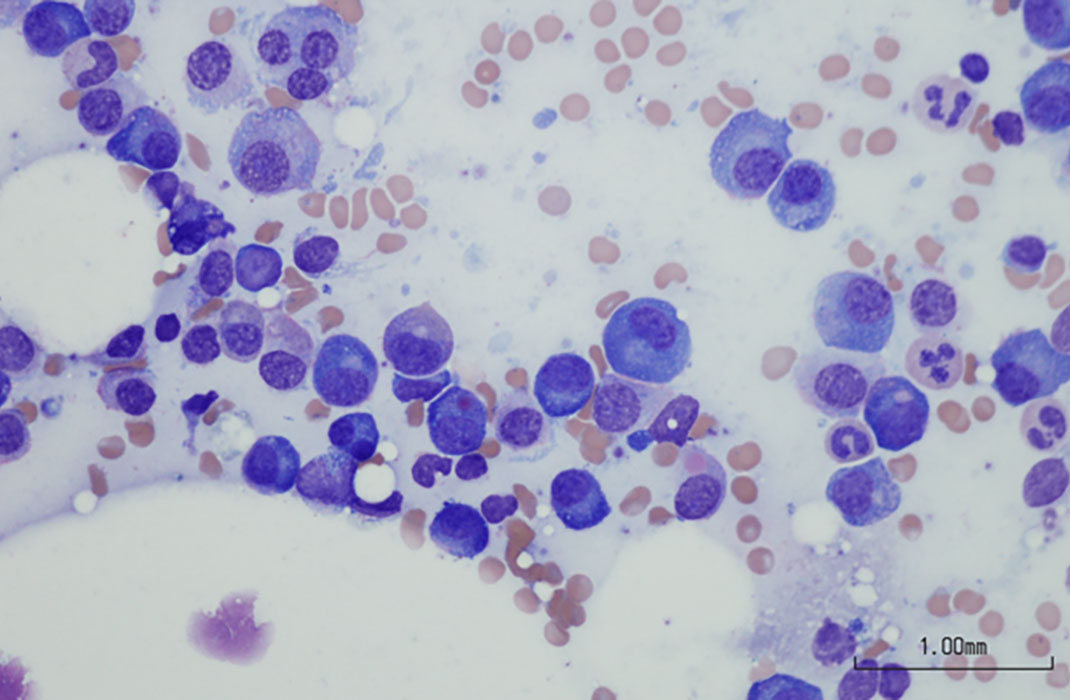 Myeloma cells under a microscope