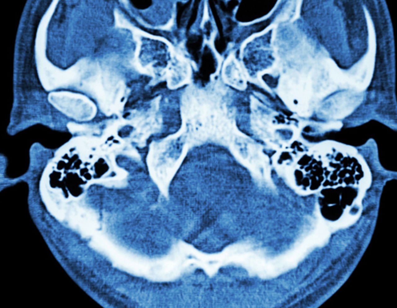 CT scan of brain and base of skull 