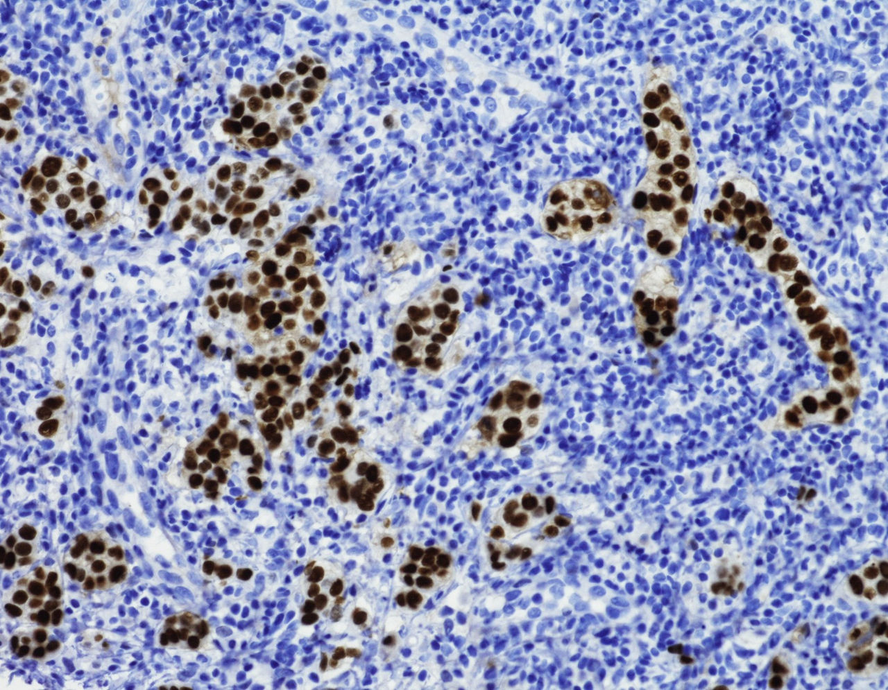 Cells showing metastatic breast cancer to lymph node