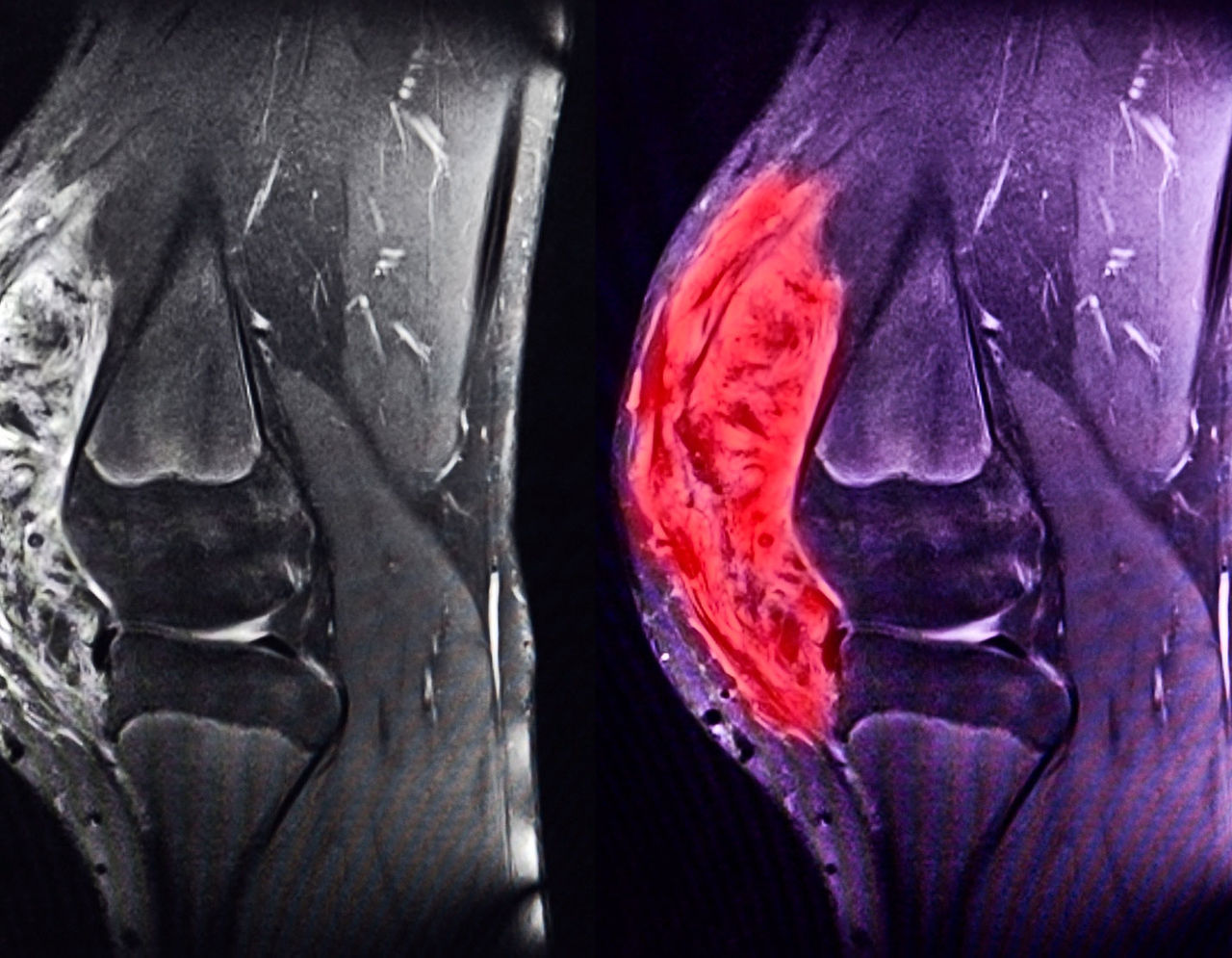 MRI scans showing a sarcoma of the knee