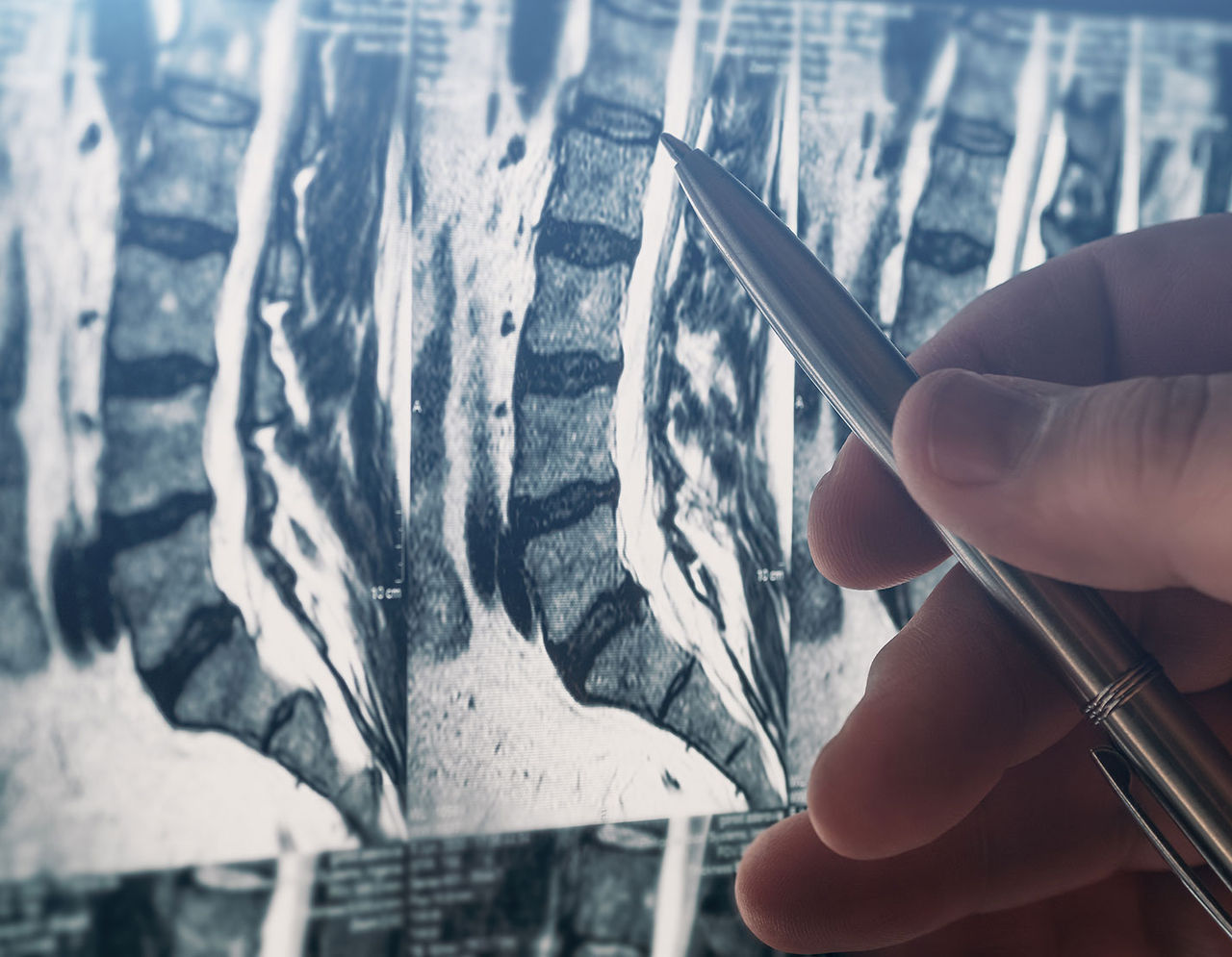 Provider pointing at image scan of lumbar spine area
