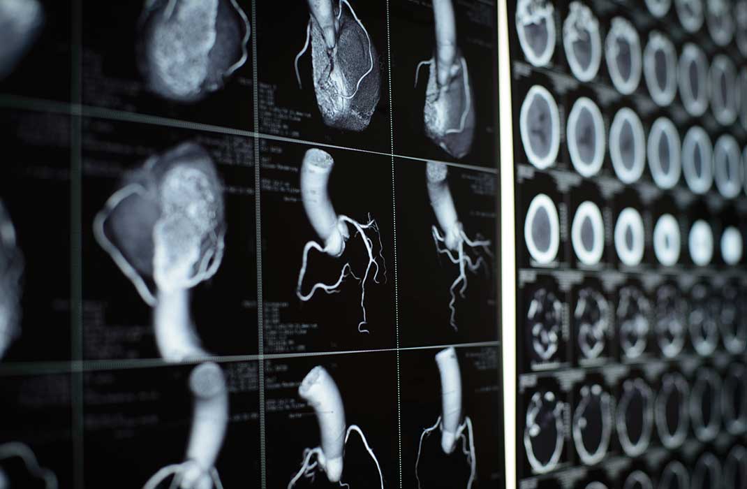 Black and white images of heart and surrounding arteries from CT scan
