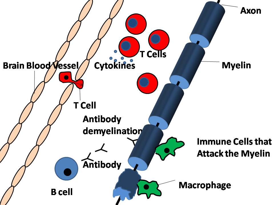 MS Diagnosis Figure