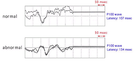 MS Diagnosis Figure