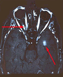 MS Diagnosis Figure