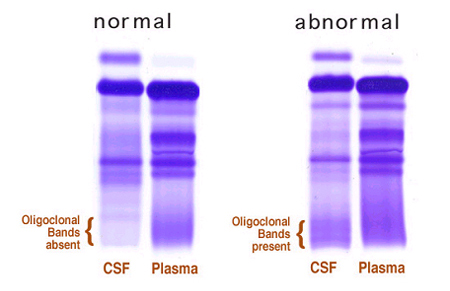 MS Diagnosis Figure