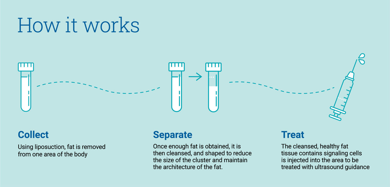 how fat transfer works, from collection using liposuction, then cleansed and shaped to reduce the size of the cluster, and then injecting the healthy fat tissue with ultrasound guidance