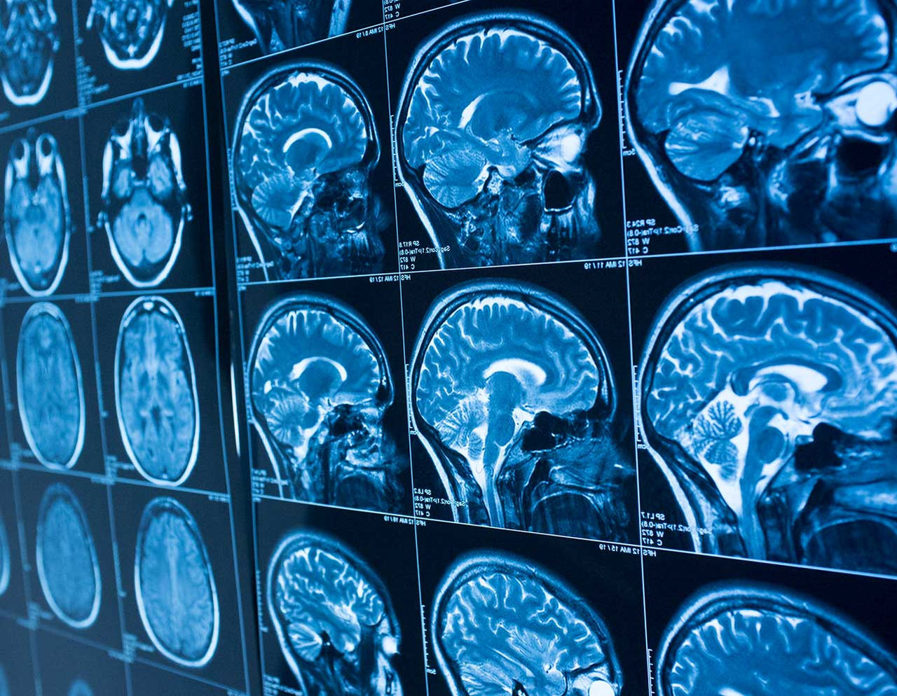 Scans of the brain from the top and side.