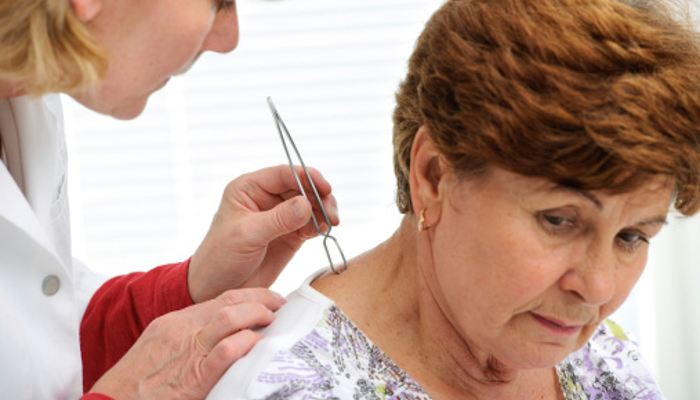 clinician removing a tick from woman's neck