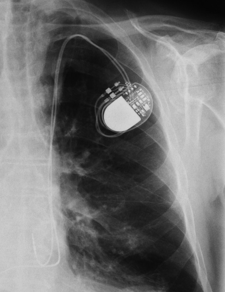 The chest X-ray shows a cardiac pacemaker implanted in the left upper chest, with visible leads extending into the heart and clear metallic components against the surrounding tissues.